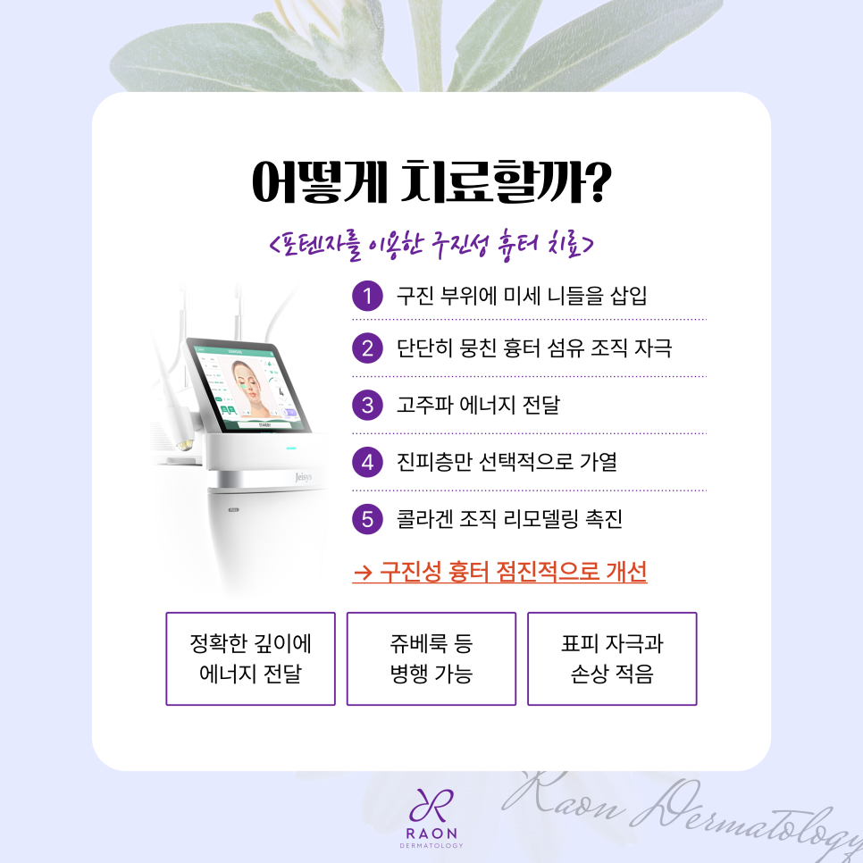왕십리 피부과 포텐자 고주파를 이용한 원데이 구진성 흉터 치료 관련 이미지 4