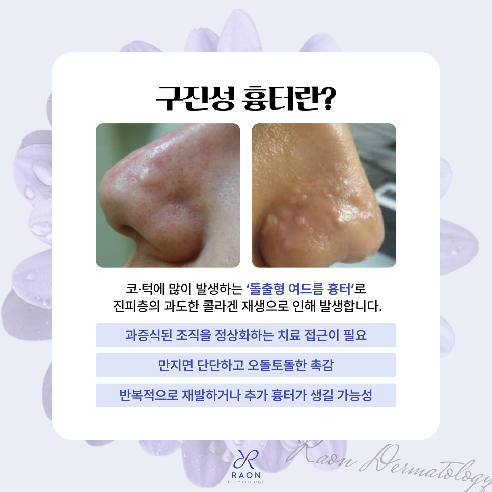Raised Scars: How Is Papular Scar Laser Treatment Performed at a Wangsimni Dermatology Clinic? image 2