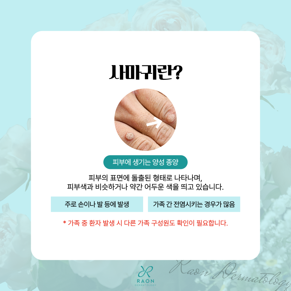 왕십리 피부과 손발 사마귀 냉동치료 및 CO2레이저 적정주기는? 관련 이미지 2