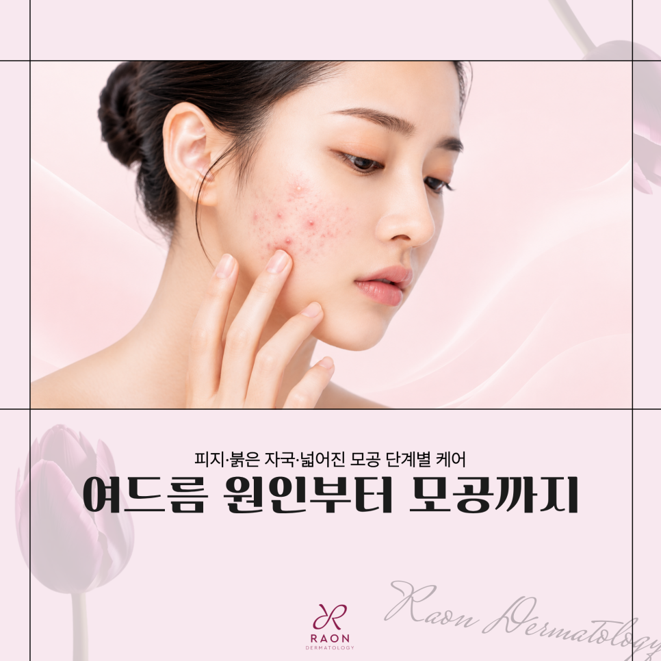 Seongdong-gu Dermatology Clinic: Step-by-Step Acne Care, from Sebum Production to Enlarged Pores image 1