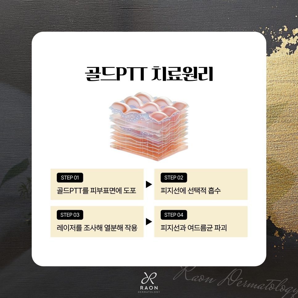 왕십리 피부과 여드름 속부터 치료하는 골드 PTT & 블랙필 효과는 관련 이미지 3