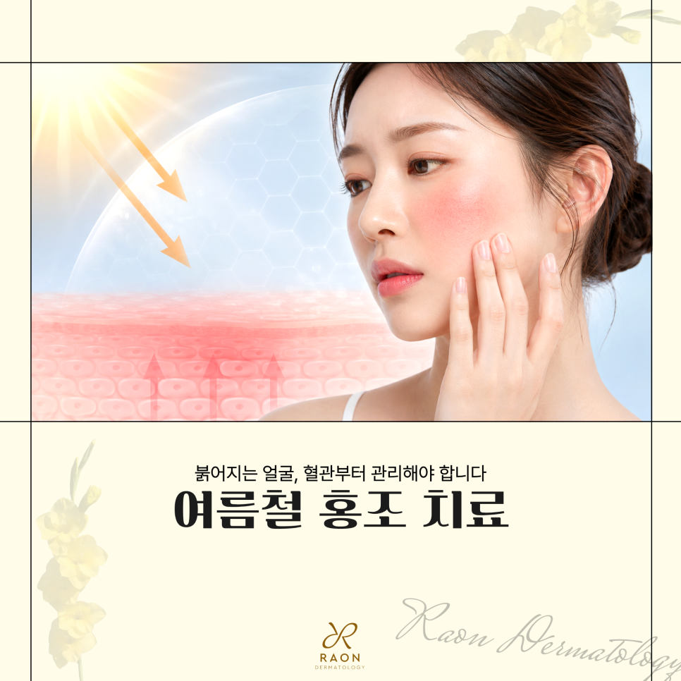 성동구 피부과 전문의 여름철 홍조의 특징 및 혈관 레이저를 이용한 치료법 관련 이미지 1