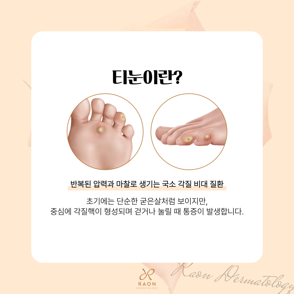 성동구 피부과 전문의의 티눈 냉동치료, 제거 후 관리방법은? 관련 이미지 2