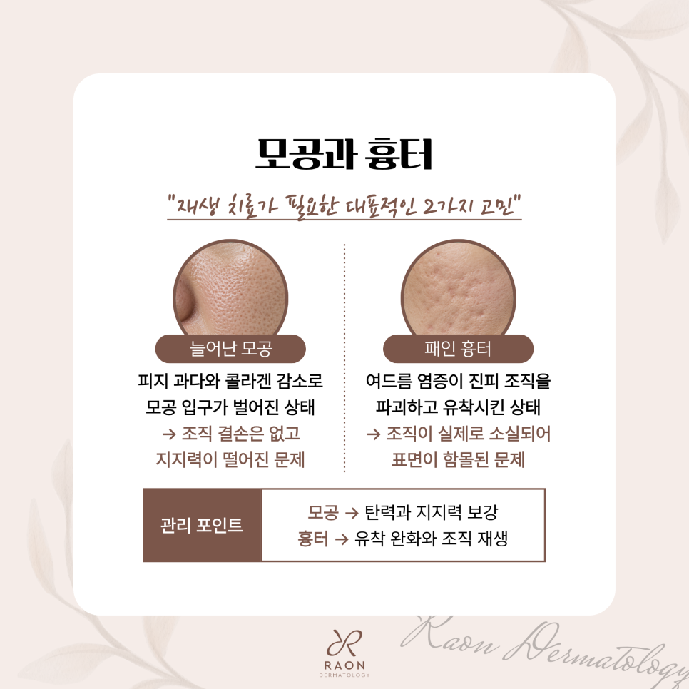 모공 및 흉터 레이저 3종 비교 왕십리 피부과 오푸스부터 포텐자, 리써FX까지 관련 이미지 2