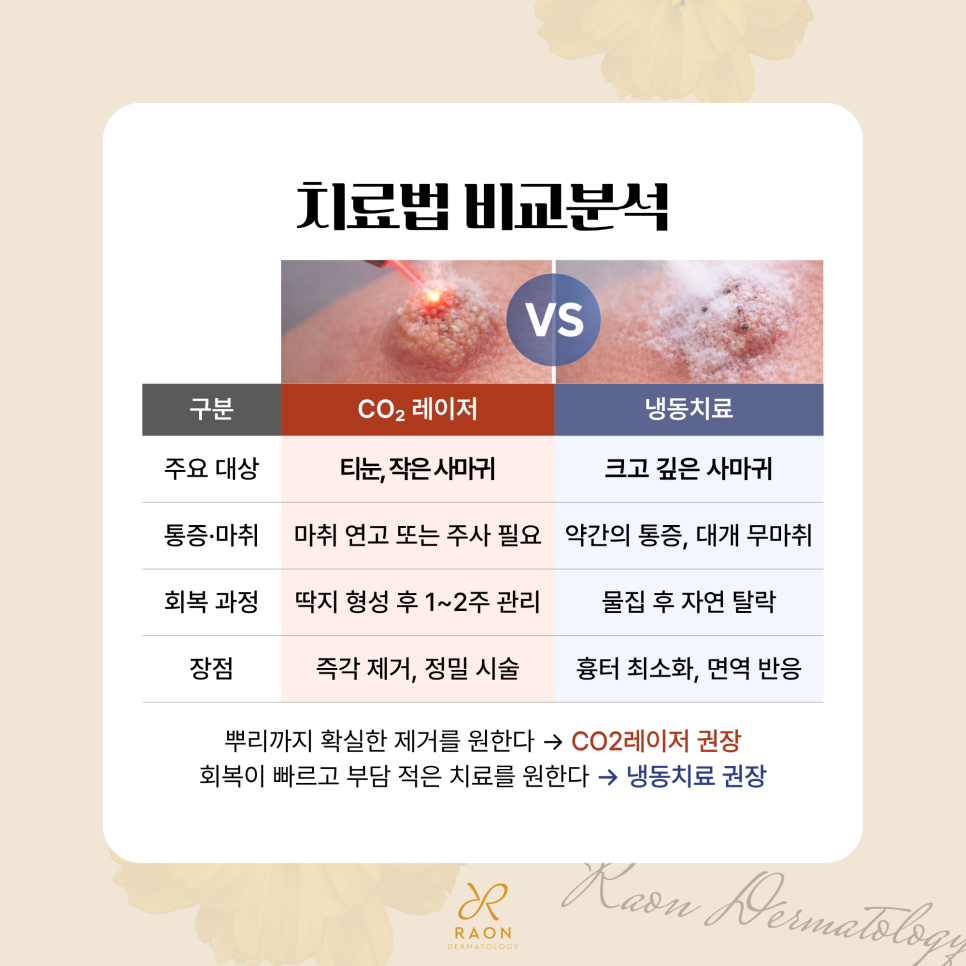 왕십리 피부과 사마귀와 티눈 등 CO2 레이저 제거, 냉동치료와의 비교 관련 이미지 6