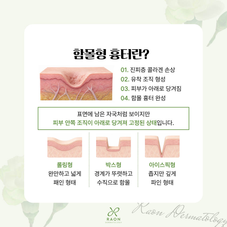 왕십리피부과 서브시전부터 미라젯, 쥬베룩까지 여러 여드름 흉터 치료법을 병행하면? 관련 이미지 2