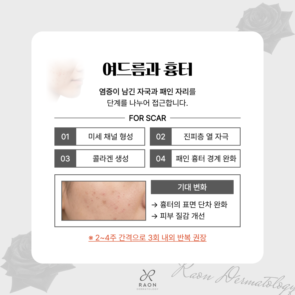 왕십리역 피부과 오푸스 레이저 신규 도입 색소부터 여드름 및 흉터까지 관련 이미지 4