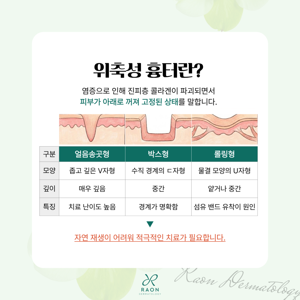 성동구 피부과 깊게 패인 위축성 흉터 치료방법 [미라젯, 포텐자, 리써FX 등] 관련 이미지 2