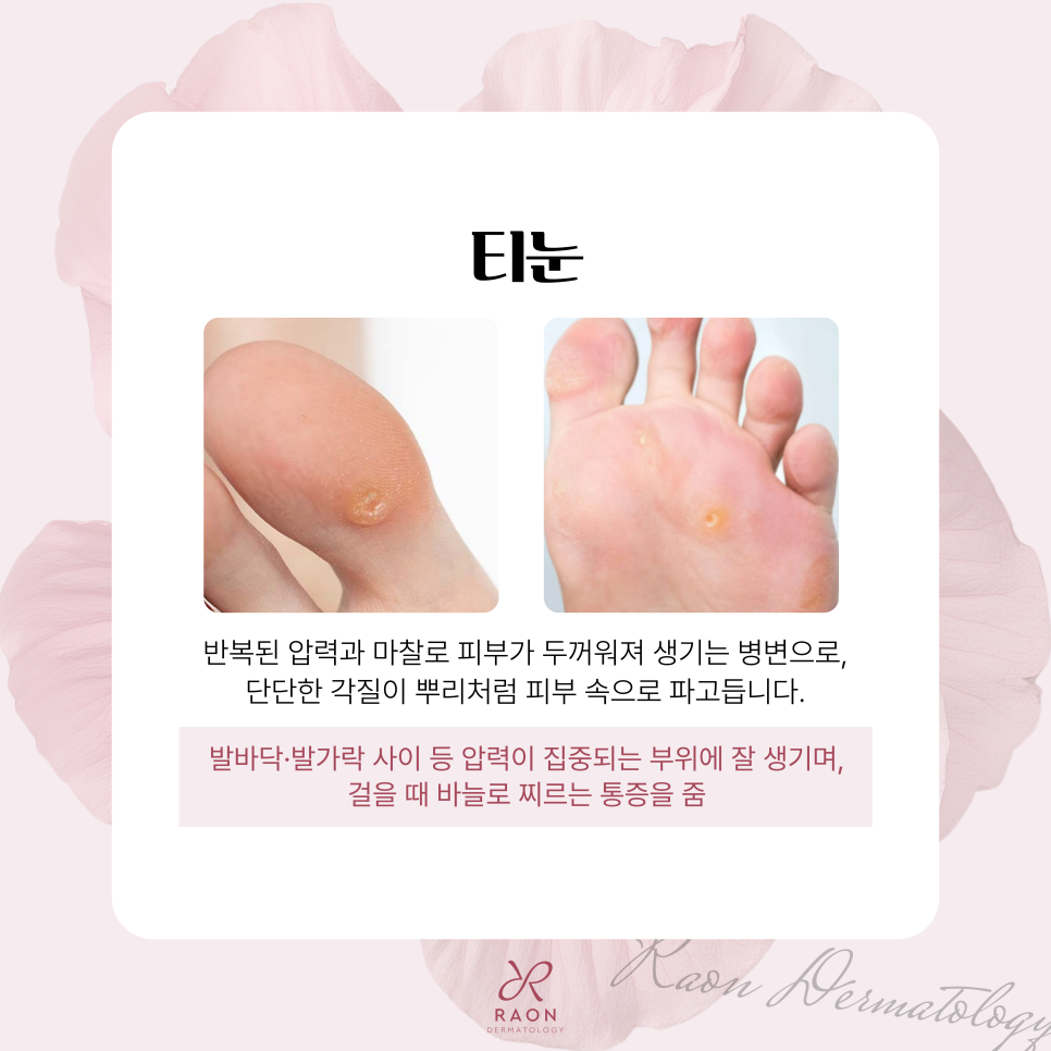 Improving Warts, Corns, and Other Epidermal Lesions with Cryotherapy and CO2 Laser at a Dermatology Clinic in Haengdang-dong image 3