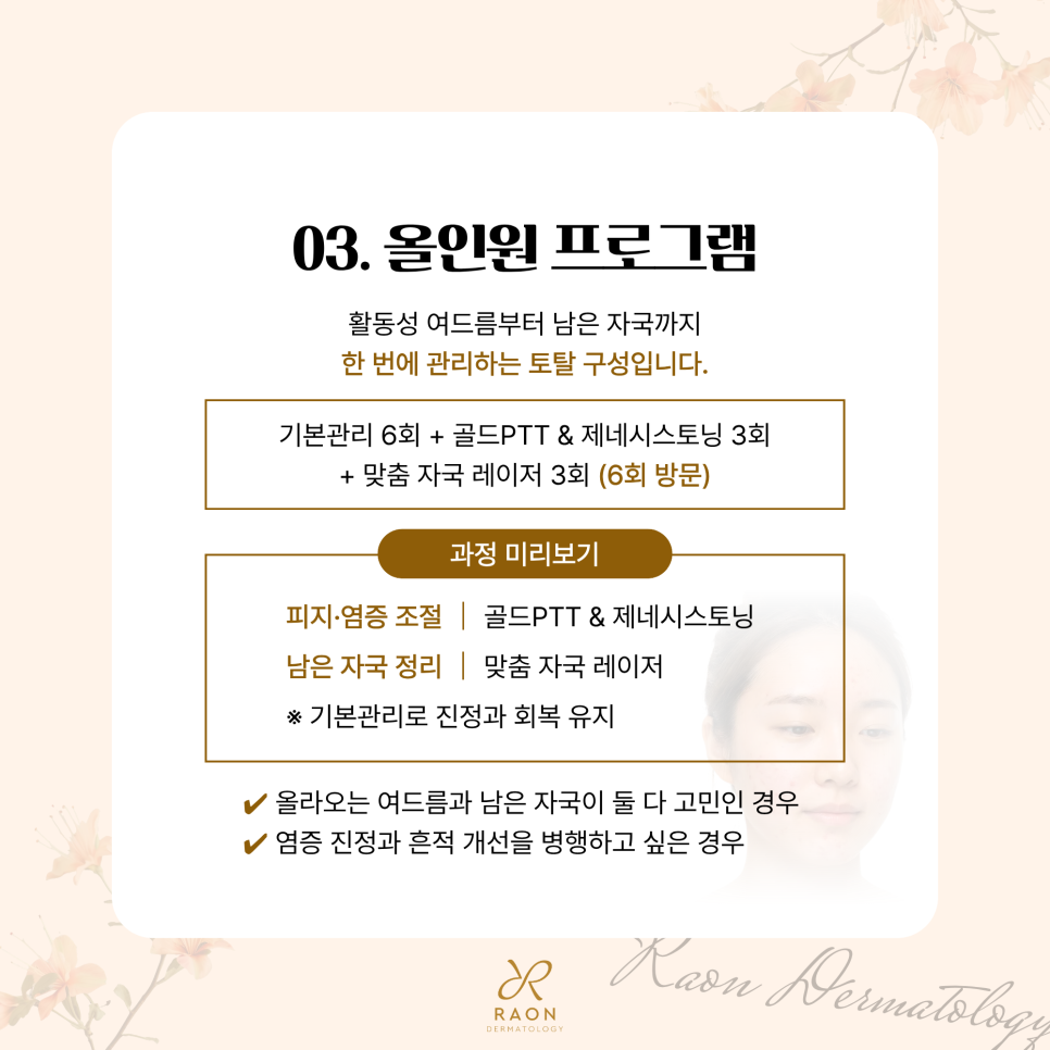 성동구 피부과 전문의 3가지 여드름 및 여드름 자국 집중 치료 과정 미리보기 관련 이미지 5