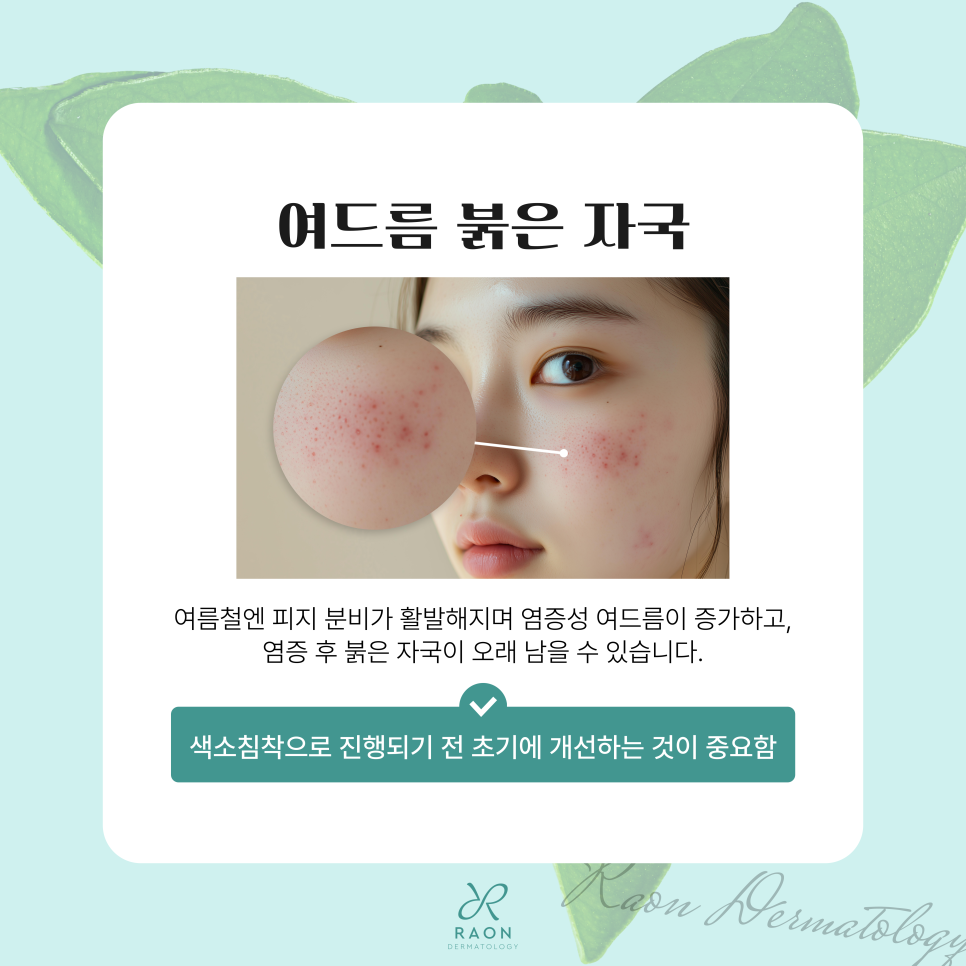 성동구 피부과 여름철 안면홍조 & 색소침착 치료 레이저, 여드름 붉은기까지 관련 이미지 5