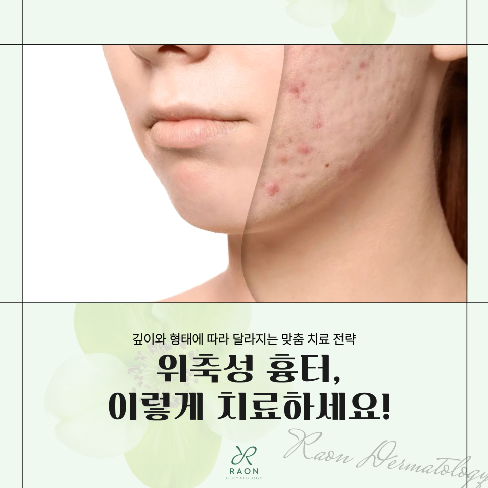성동구 피부과 깊게 패인 위축성 흉터 치료방법 [미라젯, 포텐자, 리써FX 등] 관련 이미지 1