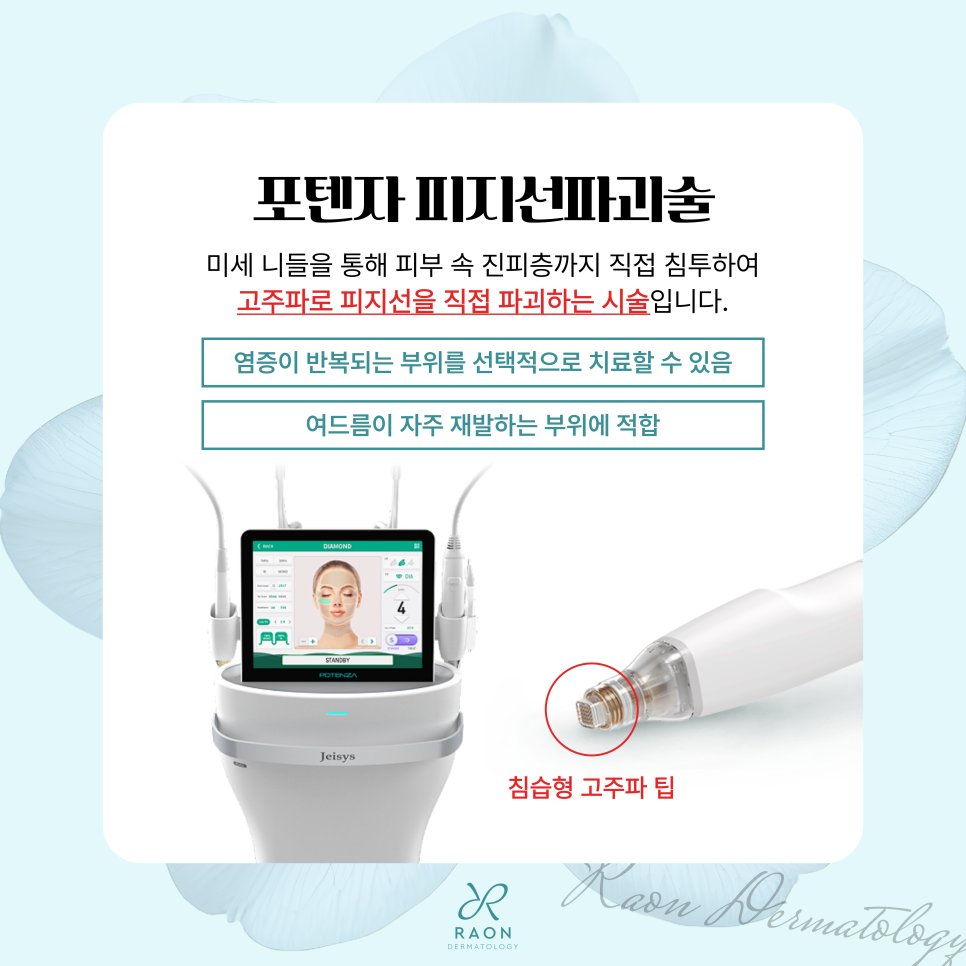 답십리 피부과 염증성 여드름 자꾸만 재발한다면? 피지선 파괴술 & 골드PTT 치료 관련 이미지 5