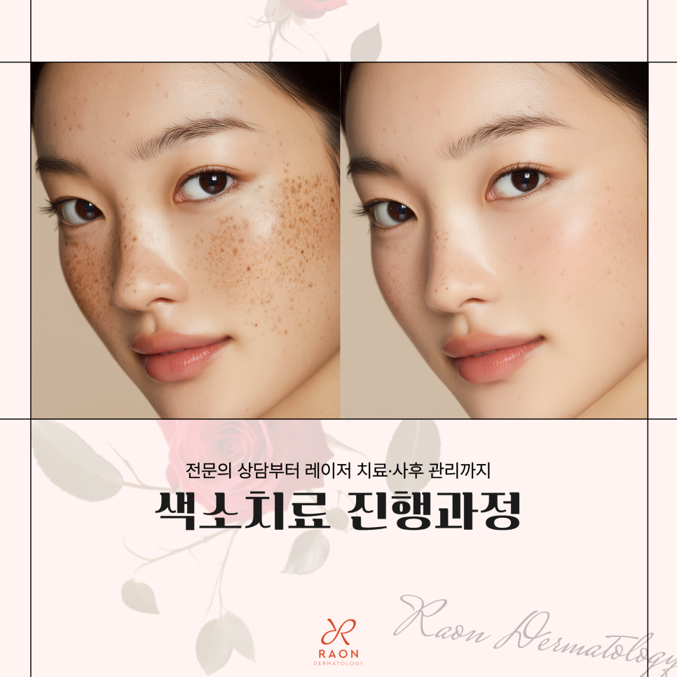 왕십리역 피부과 색소치료 진행과정 미리보기, 피부과 전문의 상담부터 치료까지 관련 이미지 1