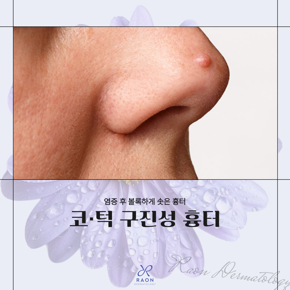 Raised Scars: How Is Papular Scar Laser Treatment Performed at a Wangsimni Dermatology Clinic? image 1