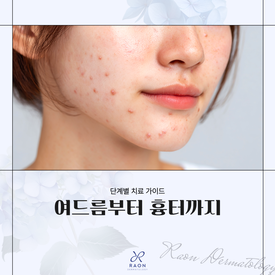 왕십리역 피부과 전문의의 여드름 원인부터 흉터, 예방까지 단계별 치료법 관련 이미지 1