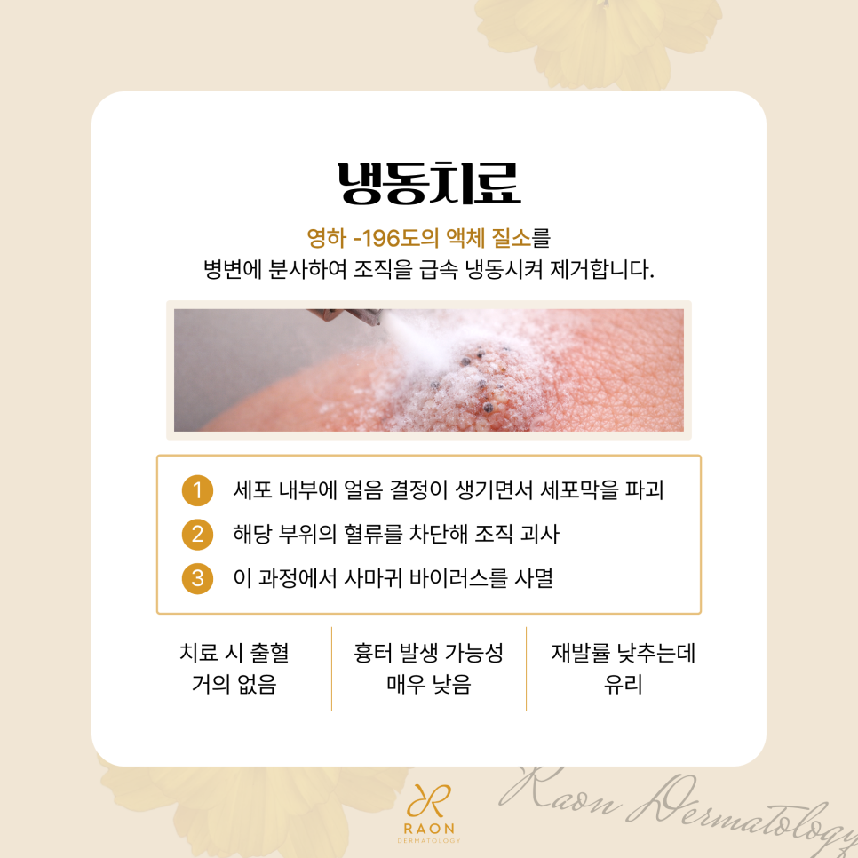 왕십리 피부과 사마귀와 티눈 등 CO2 레이저 제거, 냉동치료와의 비교 관련 이미지 5