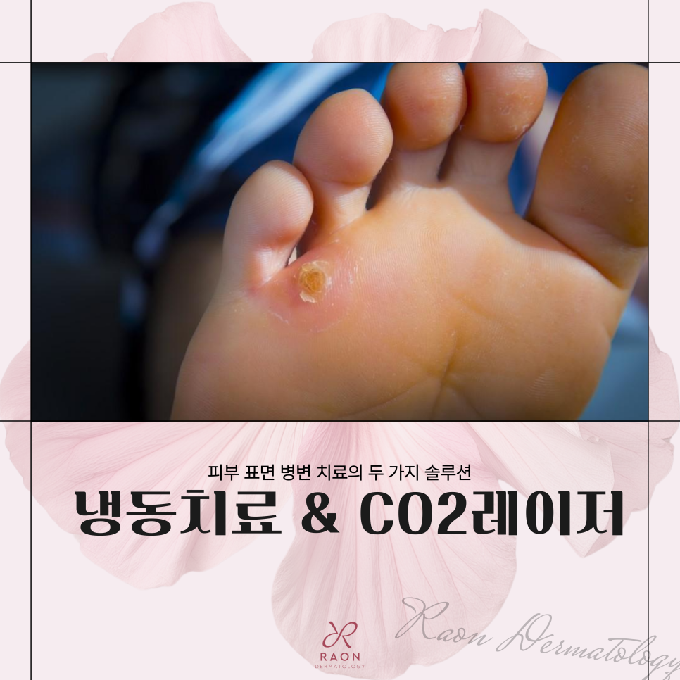Improving Warts, Corns, and Other Epidermal Lesions with Cryotherapy and CO2 Laser at a Dermatology Clinic in Haengdang-dong image 1