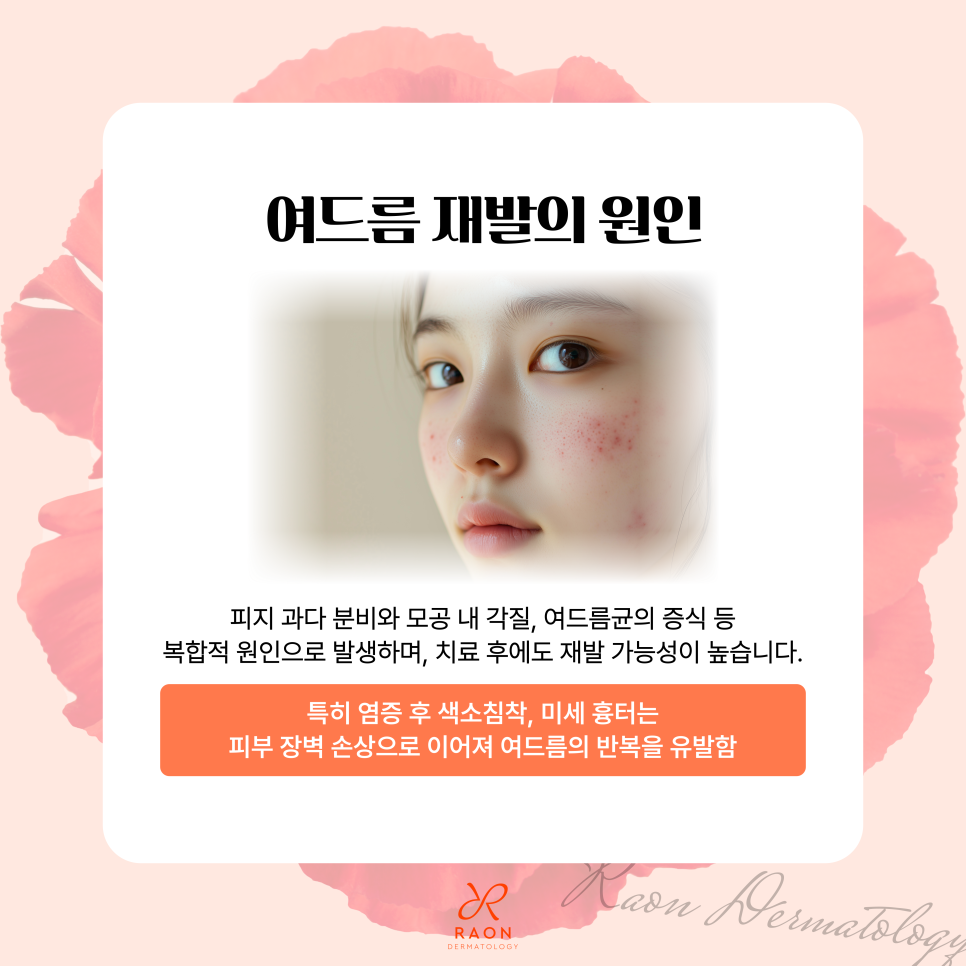 잊을만하면 올라오는 여드름? 재발까지 고려한 성동구 피부과 여드름 치료 프로세스 관련 이미지 2