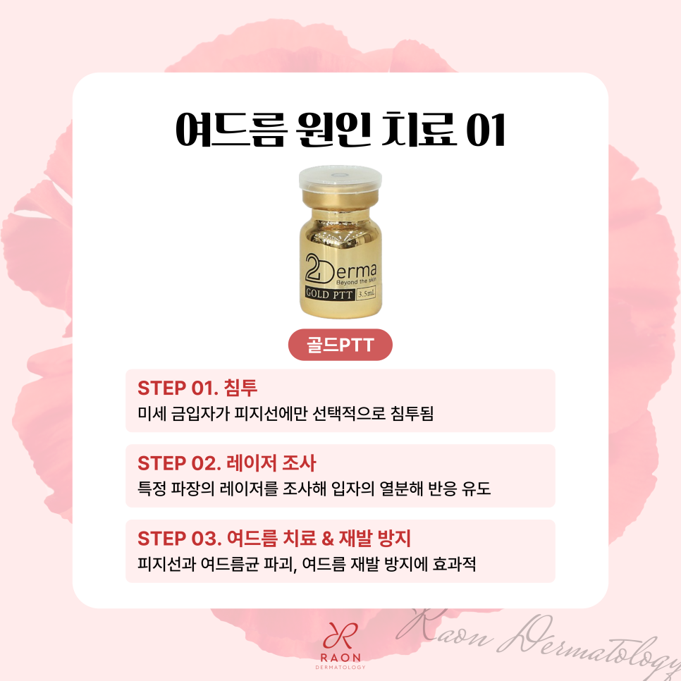 왕십리 피부과 염증성 여드름 치료, 압출만으로는 부족한 이유? 관련 이미지 3