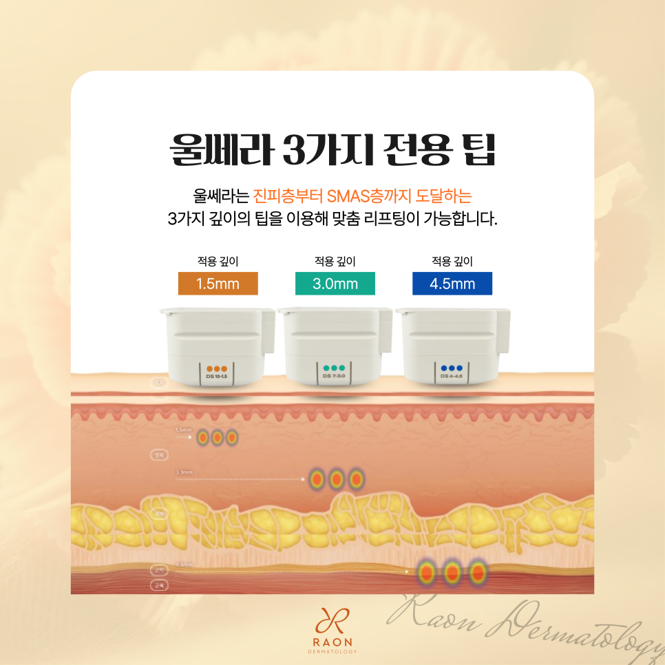 왕십리 피부과 전문의 울쎄라 리프팅, 심부볼과 이중턱에 좋은 이유? 관련 이미지 3