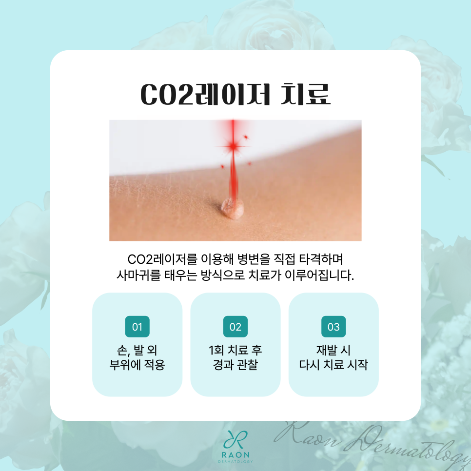 왕십리 피부과 손발 사마귀 냉동치료 및 CO2레이저 적정주기는? 관련 이미지 6