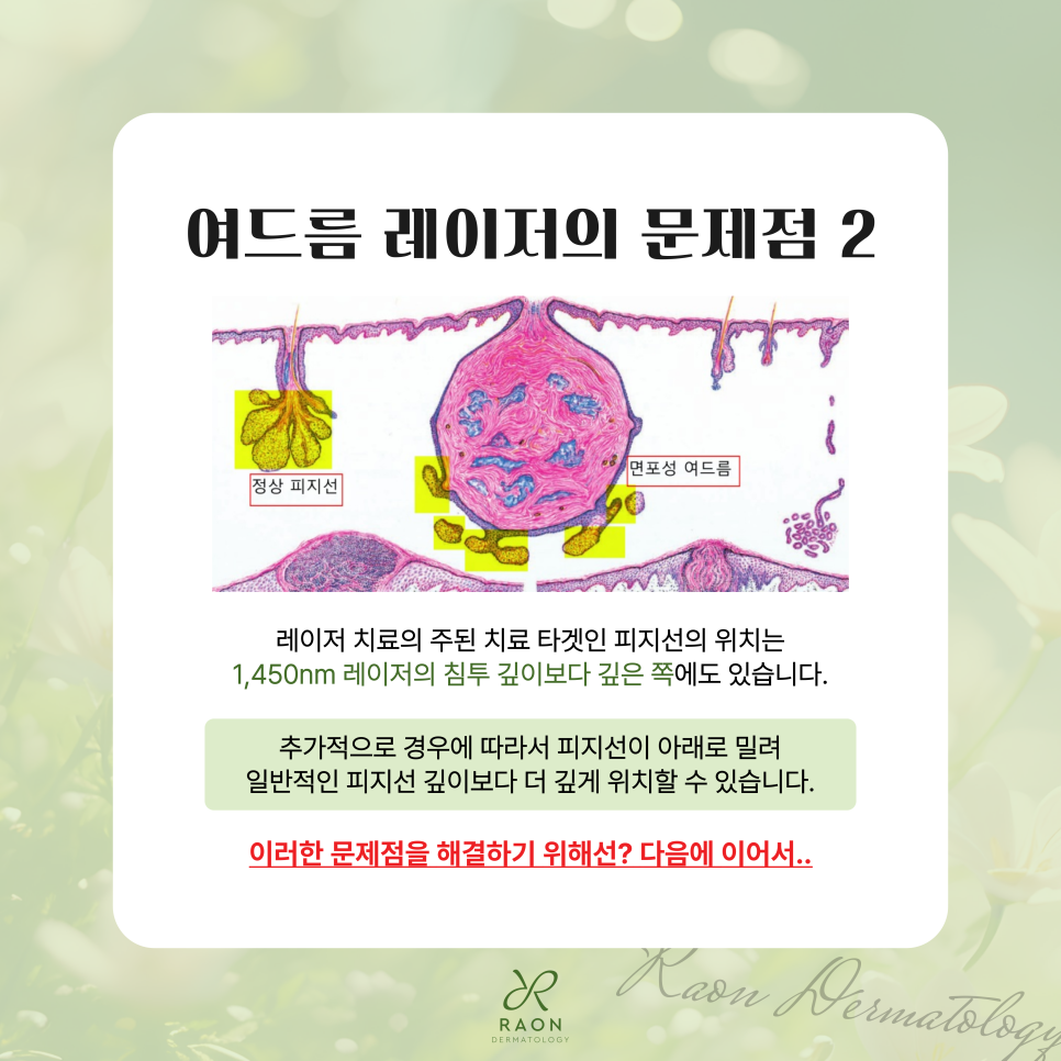 Chief Director’s Skin Column｜What Are the Limitations of Acne Laser Treatment at a Dermatology Clinic in Haengdang-dong? image 6