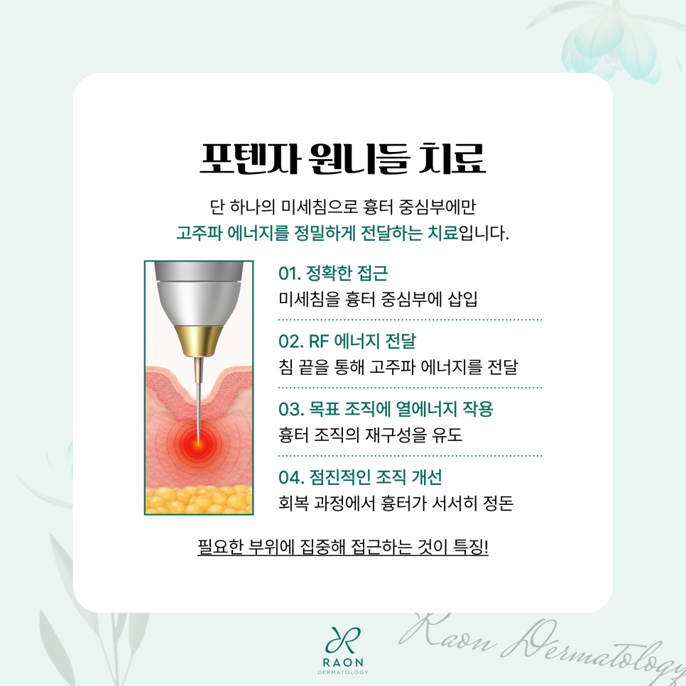 왕십리 피부과 포텐자 원니들 구진성 흉터 및 비후성 반흔 치료는 뭐가 다를까? 관련 이미지 4