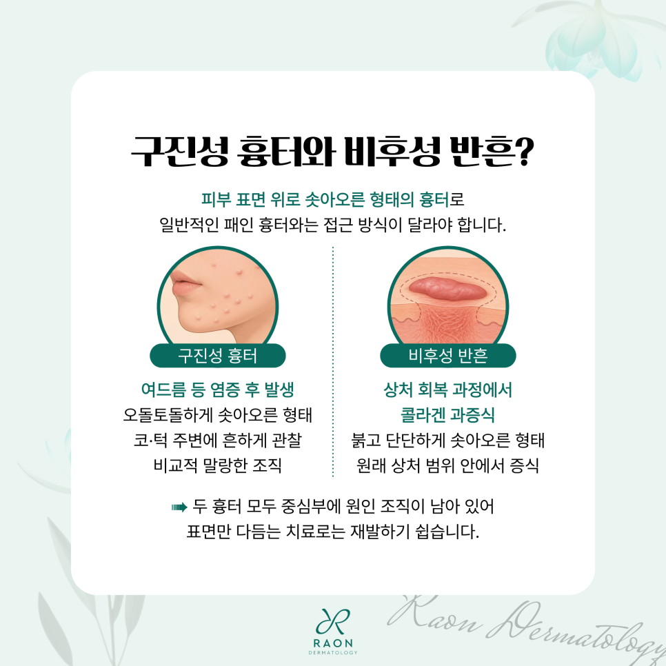 왕십리 피부과 포텐자 원니들 구진성 흉터 및 비후성 반흔 치료는 뭐가 다를까? 관련 이미지 2