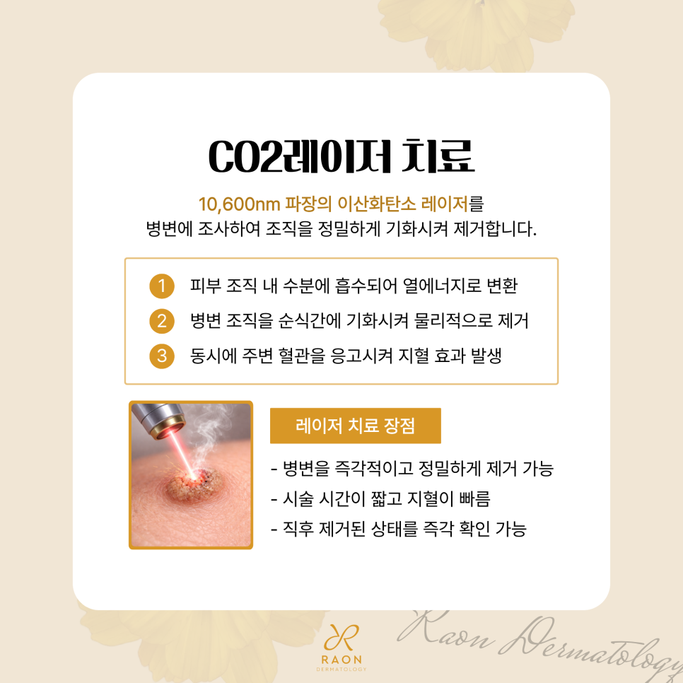 왕십리 피부과 사마귀와 티눈 등 CO2 레이저 제거, 냉동치료와의 비교 관련 이미지 4