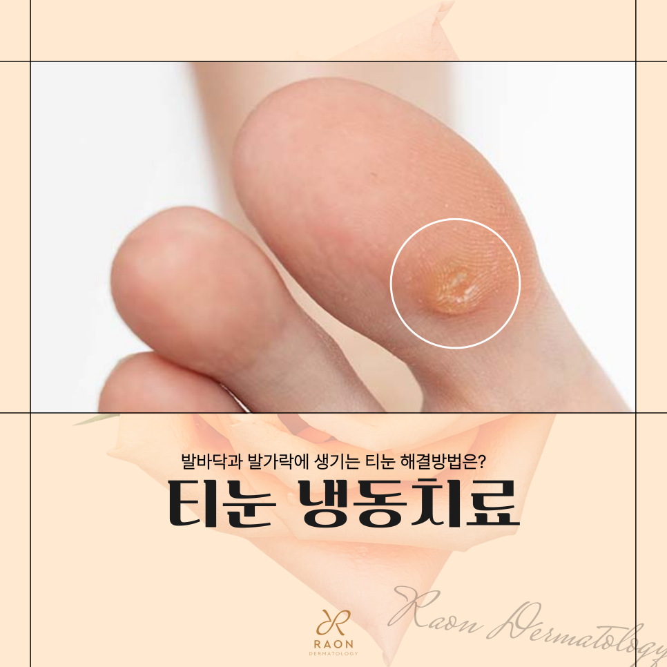 성동구 피부과 전문의의 티눈 냉동치료, 제거 후 관리방법은? 관련 이미지 1