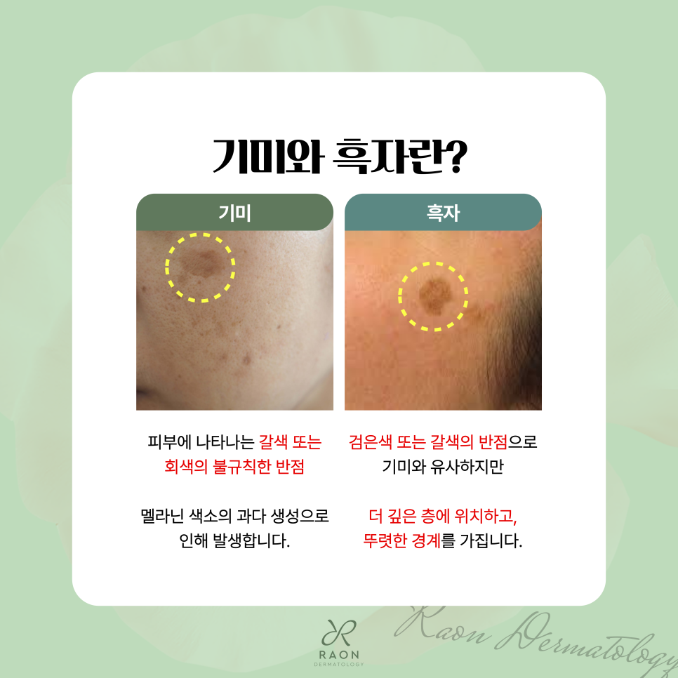 Sangwangsimni Dermatology: How Should Melasma and Solar Lentigo Laser Toning Be Treated? image 2