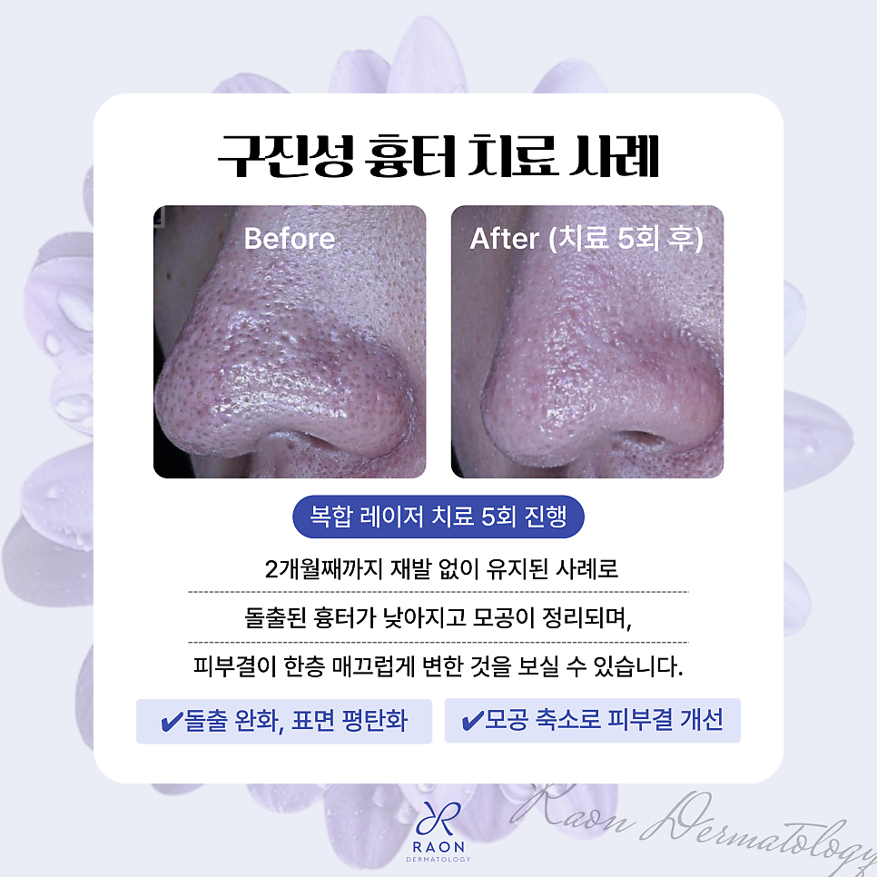 Raised Scars: How Is Papular Scar Laser Treatment Performed at a Wangsimni Dermatology Clinic? image 6