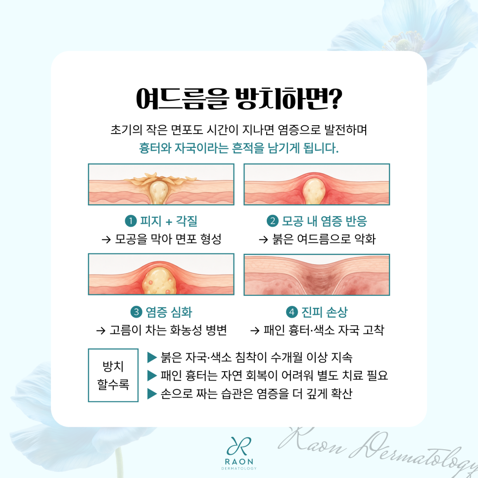Dermatologist in Gwangjin-gu: The Basics of Acne Care, from Acne Extraction to Sebum and Scars image 2