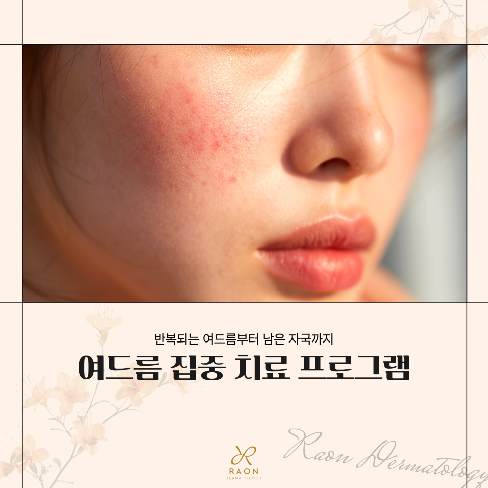 성동구 피부과 전문의 3가지 여드름 및 여드름 자국 집중 치료 과정 미리보기 관련 이미지 1