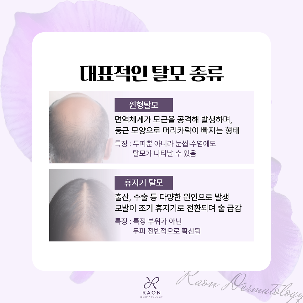 Wangsimni Dermatology Clinic: Various Hair Loss Treatments, from Triamcinolone Injections to Prevention Habits image 3