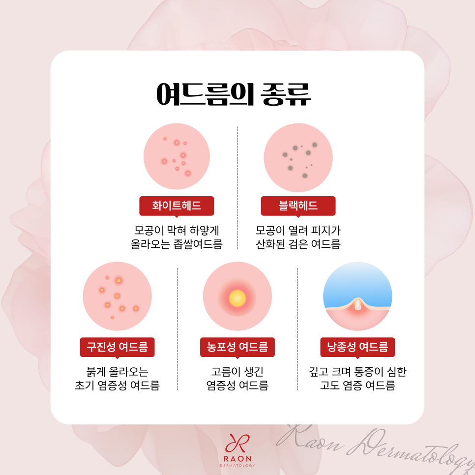 Recurring Acne That Keeps Coming Back: Acne Treatment Methods by Type at Haengdang Station Dermatology Clinic (Including Sebaceous Gland Destruction, Black Peel) image 2