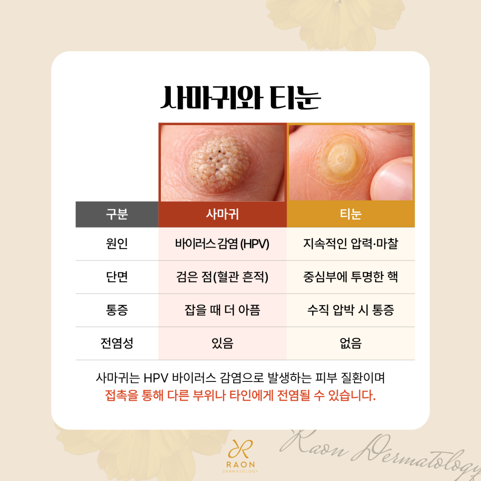 왕십리 피부과 사마귀와 티눈 등 CO2 레이저 제거, 냉동치료와의 비교 관련 이미지 2