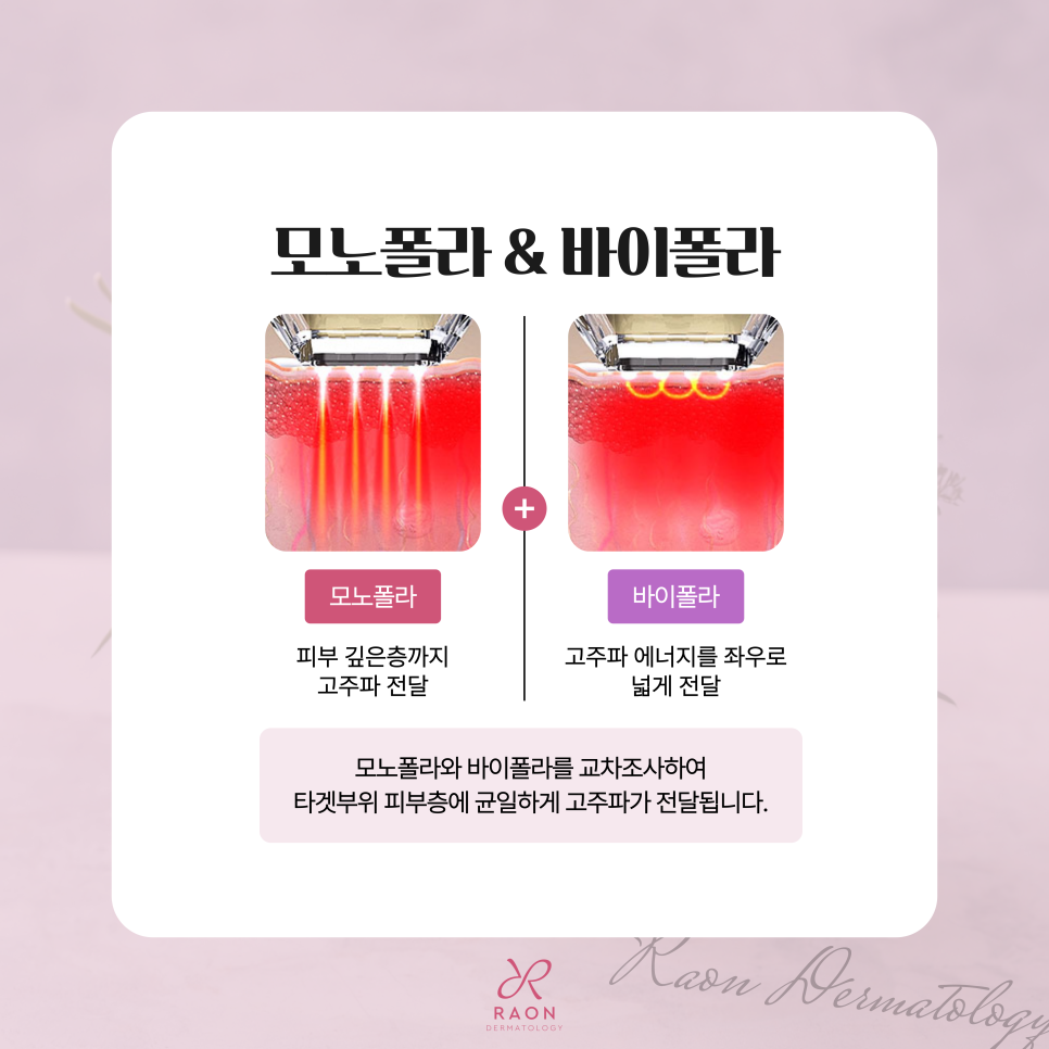 행당역 피부과 리프팅시술로 안면부 처짐 개선하기 (울쎄라 &middot; 포텐자 다이아) 관련 이미지 5