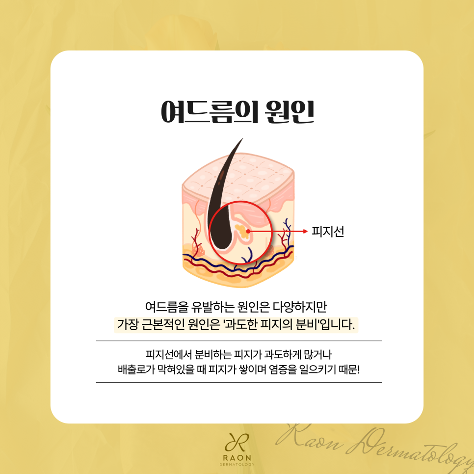 왕십리 피부과 전문의의 여드름 치료 골드PTT로 피지 억제 가능할까 관련 이미지 2