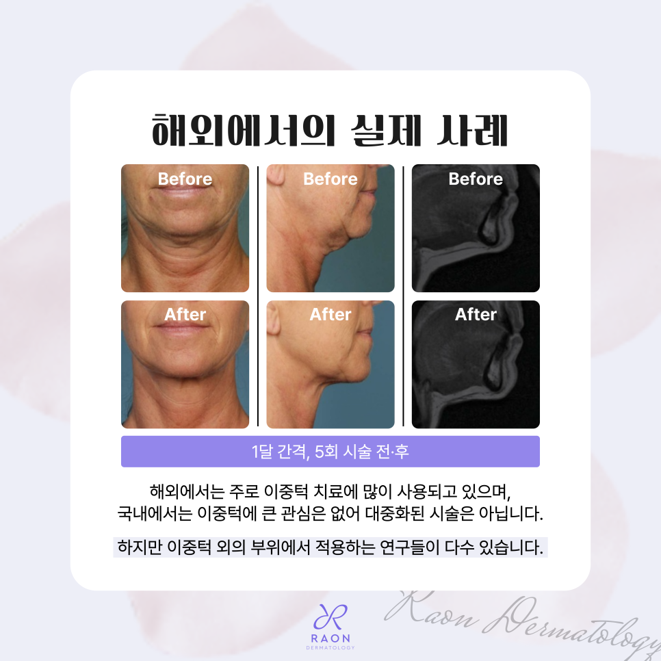 Chief Director’s Skin Column｜Seongdong-gu Dermatology: What Are the Real Uses of Fat-Dissolving Injections Such as V-OLET? image 5