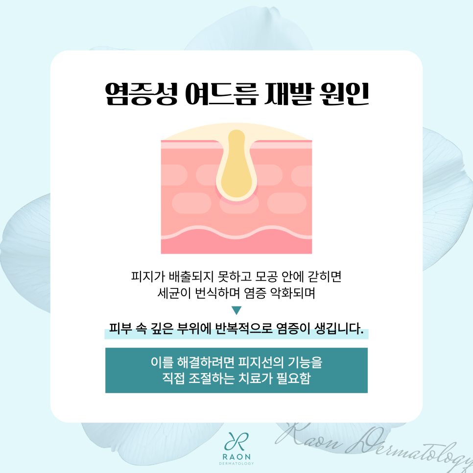 답십리 피부과 염증성 여드름 자꾸만 재발한다면? 피지선 파괴술 & 골드PTT 치료 관련 이미지 2