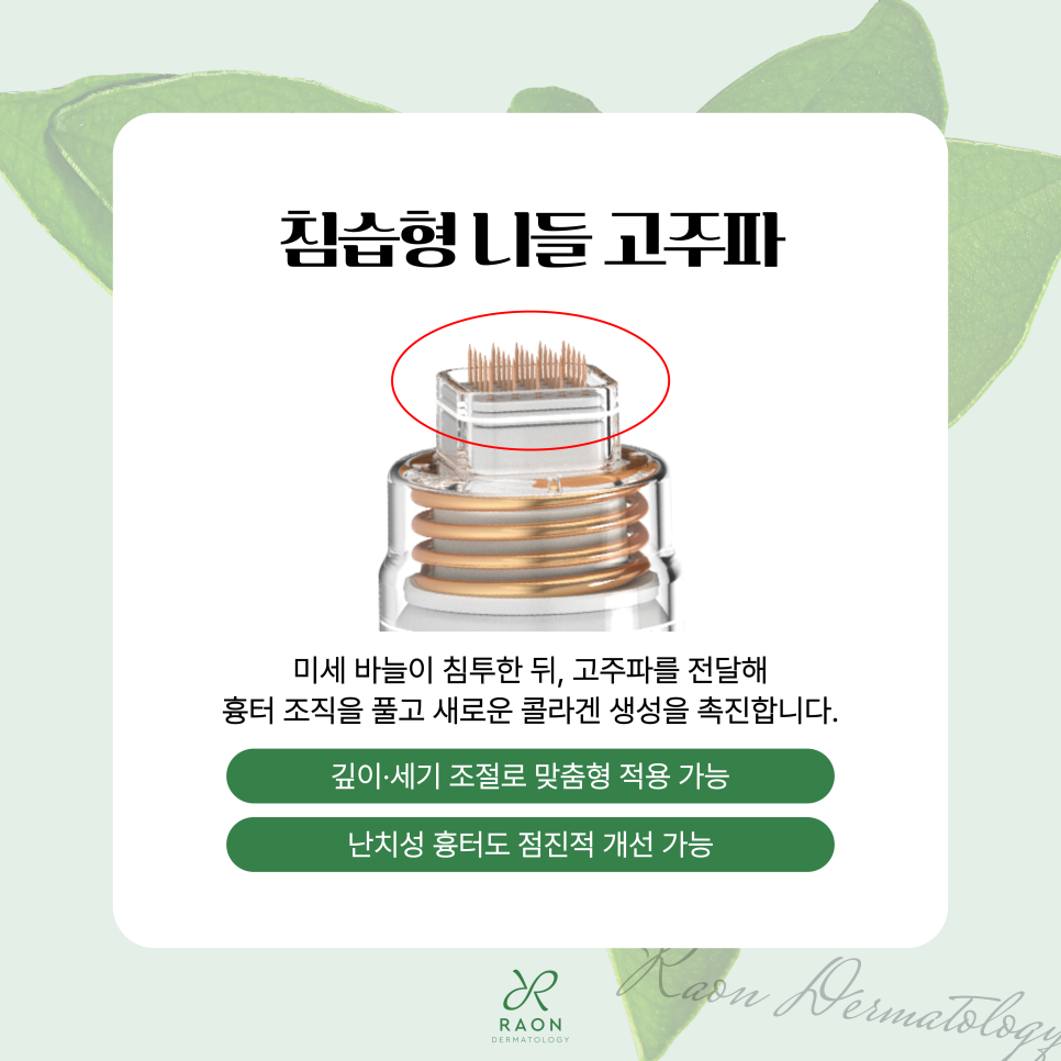 금호동 피부과 포텐자 고주파로 흉터 및 모공 문제 개선하기 관련 이미지 4