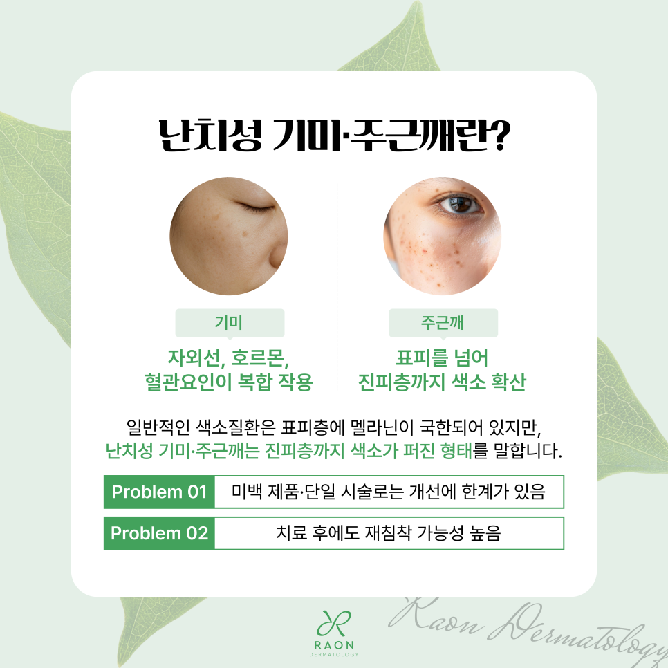 성수피부과 난치성 기미 및 주근깨 피부과 전문의 진료 후 레이저 토닝 치료 관련 이미지 2