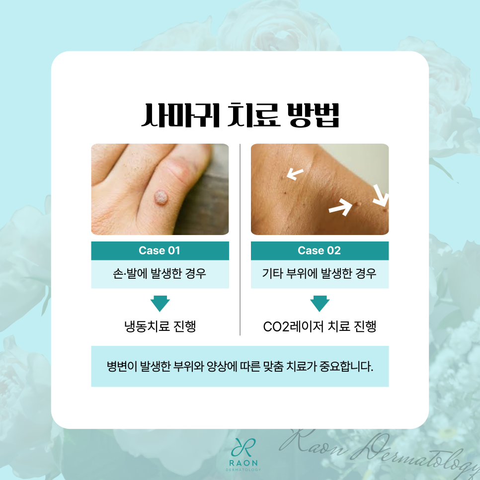 왕십리 피부과 손발 사마귀 냉동치료 및 CO2레이저 적정주기는? 관련 이미지 3