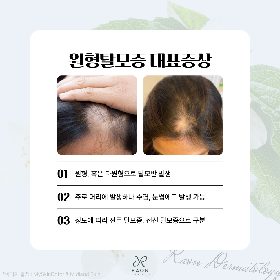 성동구 피부과 원형탈모증 트리암시놀론 주사, 초기 탈모 치료효과는? 관련 이미지 4