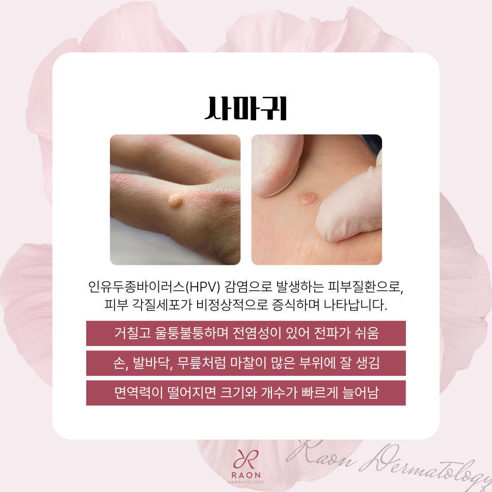 Improving Warts, Corns, and Other Epidermal Lesions with Cryotherapy and CO2 Laser at a Dermatology Clinic in Haengdang-dong image 2