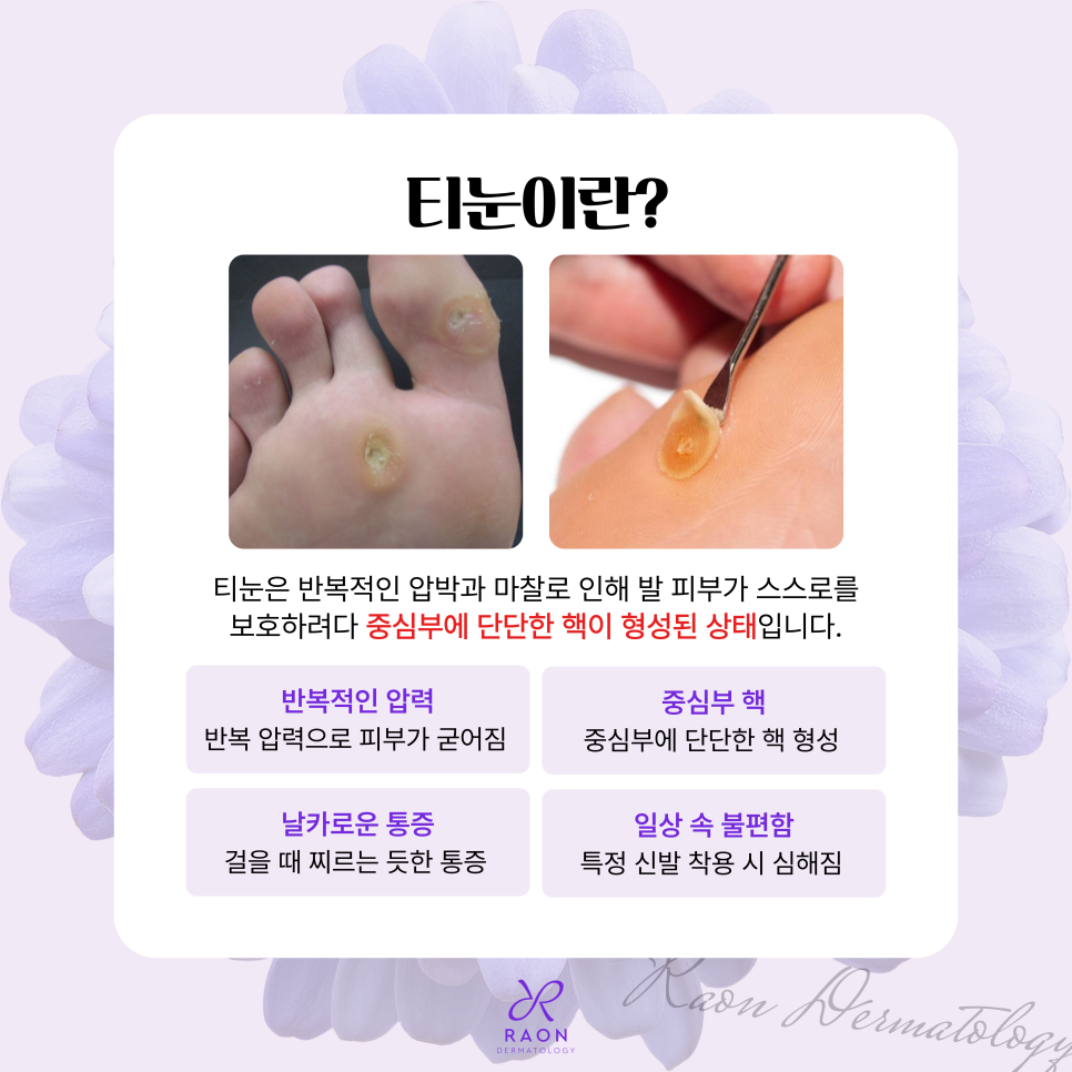 금호동 피부과 전문의 겨울철 티눈 치료는 이렇게, 더 효과적인 치료 방법은? 관련 이미지 2