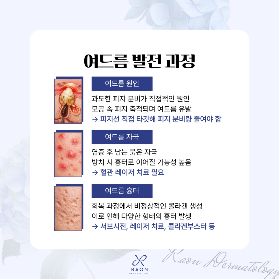 왕십리역 피부과 전문의의 여드름 원인부터 흉터, 예방까지 단계별 치료법 관련 이미지 2