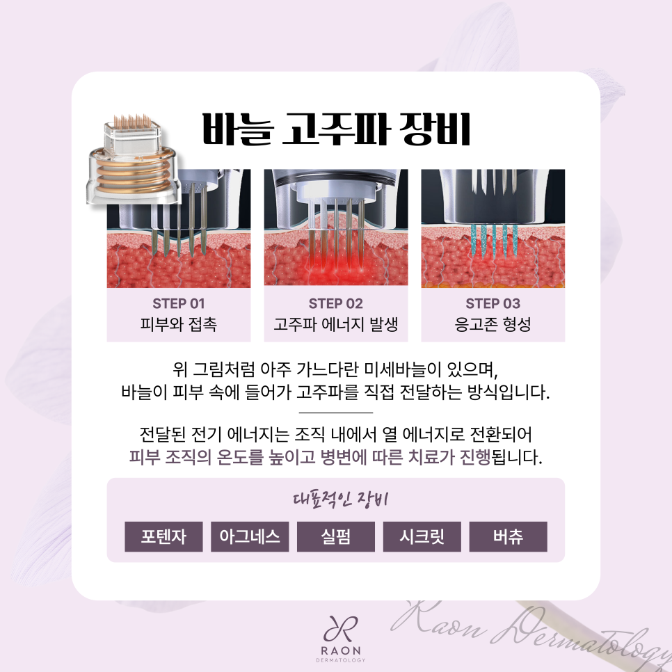 왕십리역 피부과 전문의 여드름 등 바늘 고주파 시술 이해하기 [백종헌 원장 칼럼] 관련 이미지 4